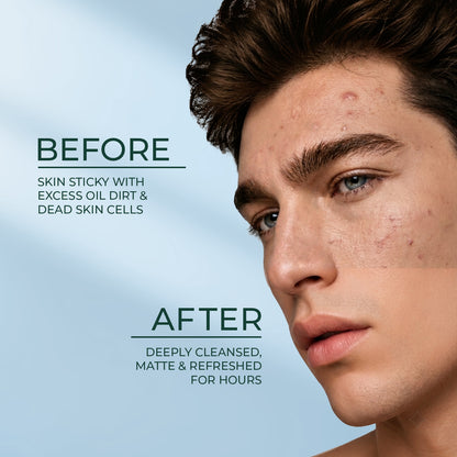 Acne Clear Face Wash 50GM | DENVER